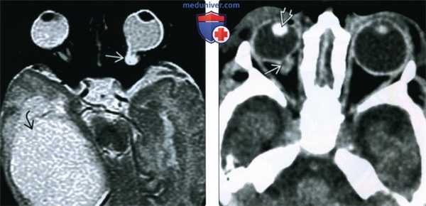 КТ, МРТ при колобоме