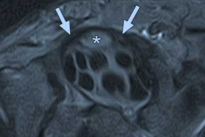 отек медианного нерва