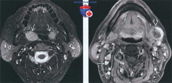 КТ, МРТ при неходжкинской лимфоме слизистой оболочки глотки