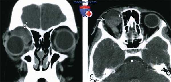 КТ, МРТ при лимфатической мальформации глазницы