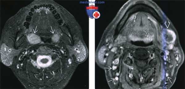 КТ, МРТ при неходжкинской лимфоме слизистого пространства глотки