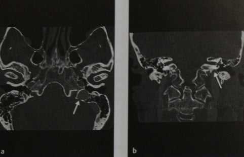 Снимки МРТ и КТ. Высокое расположение яремной луковицы