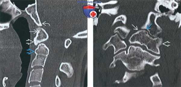 КТ, МРТ при зубовидной кости