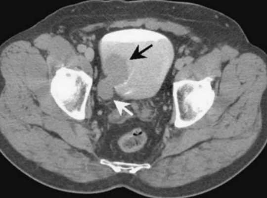Симптомы онкозаболеваний мочевого пузыря