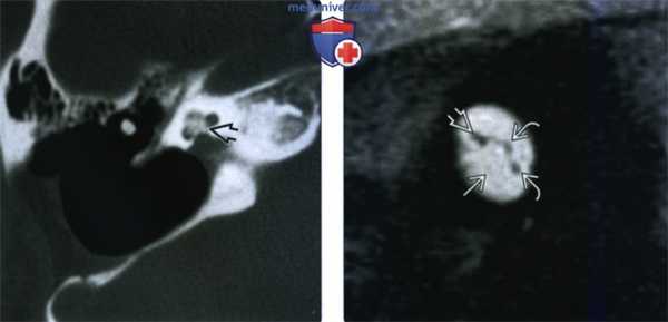 КТ, МРТ при оссифицирующем лабиринтите