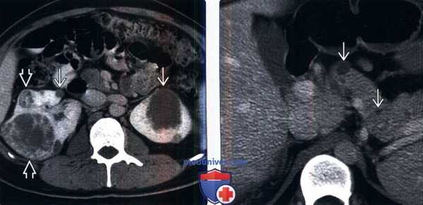 КТ, МРТ при болезни Гиппеля-Линдау
