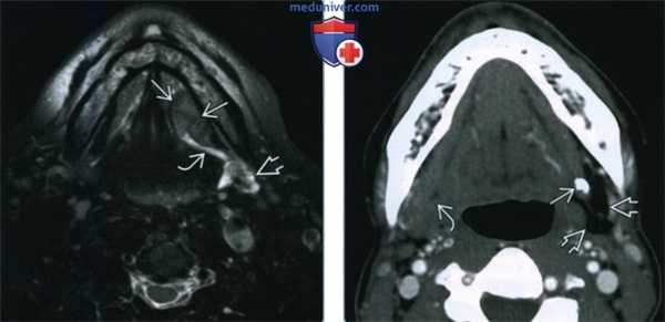 Сиаладенит поднижнечелюстной слюнной железы - лучевая диагностика
