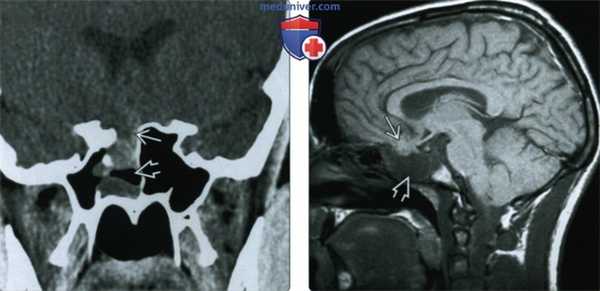 КТ, МРТ при цефалоцеле основания черепа