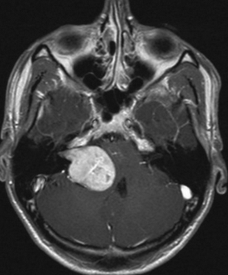 Невринома слухового нерва на МРТ