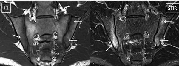 МРТ крестцово-подвздошных суставов