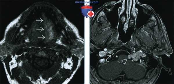 Шваннома подъязычного нерва - лучевая диагностика