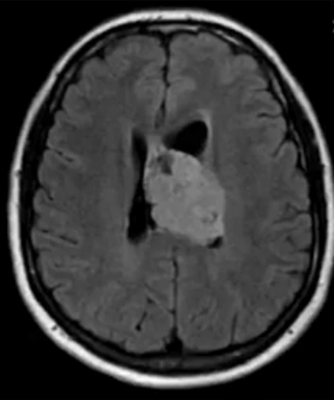 Эпендимома при МРТ