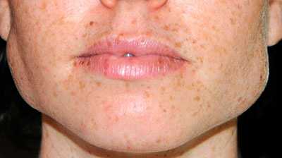 Гипертрофия жевательных мышц