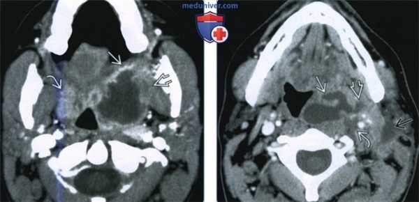 Миндаликовый и паратонзиллярный абсцесс - лучевая диагностика