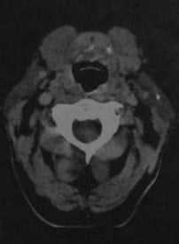 Снимки МРТ и КТ. Сиалолитиаз, сиаладенит