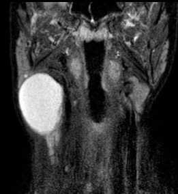 бранхиальная киста-обр