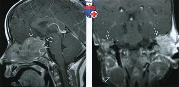 КТ, МРТ при лангергансоклеточном гистиоцитозе основания черепа