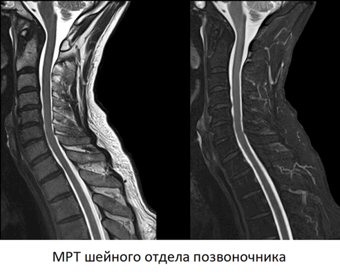 МРТ шейного отдела позвоночника