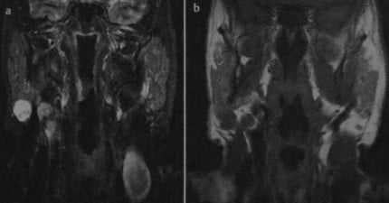 Снимки МРТ и КТ. Опухоль Уортина