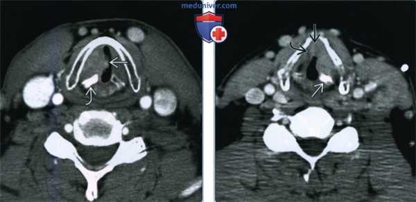 Плоскоклеточный рак гортани - лучевая диагностика