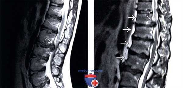 Рентгенограмма, КТ, МРТ болезни Шейерманна