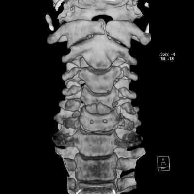 КТ позвоночника