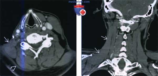 Гипертрофия мышцы поднимающей лопатку - лучевая диагностика