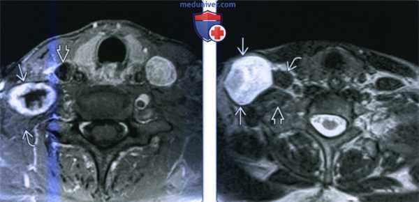 Шваннома плечевого сплетения - лучевая диагностика