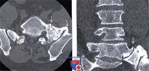 КТ при синдроме Бертолотти