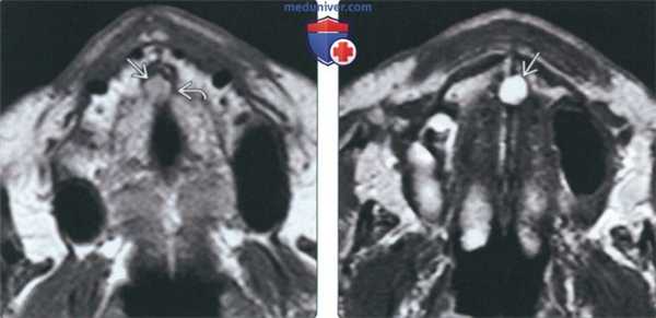 Рентгенограмма, КТ, МРТ при кисте носонебного протока