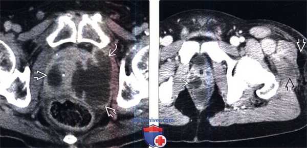 КТ, МРТ при простатите и абсцессе простаты