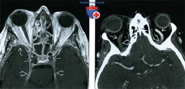 КТ, МРТ при осложнениях риносинусита