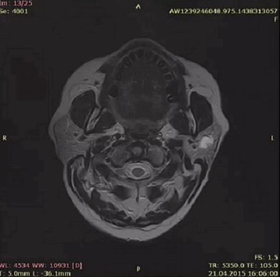МРТ слюнных желез с контрастом