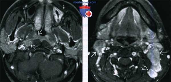 КТ, МРТ при раке носоглотки
