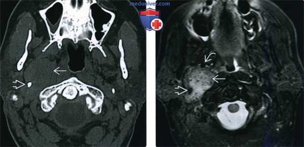 КТ, МРТ при вагальной параганглиоме