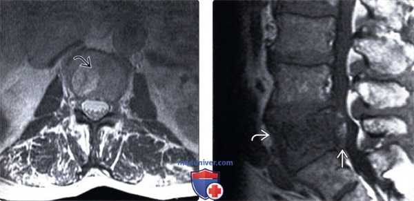 МРТ гемангиомы позвоночника
