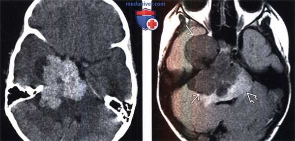 Атипичная и злокачественная менингиома на КТ, МРТ