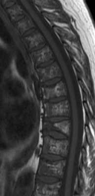 Литические очаги в позвонках и компрессионные переломы.