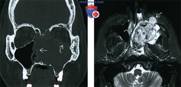 Организовавшаяся гематома пазухи, носа - лучевая диагностика