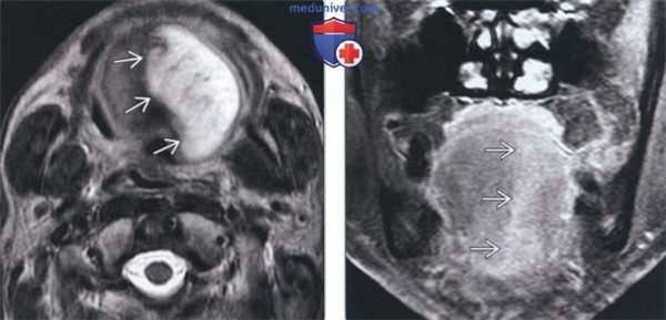 Лучевая диагностика двигательной денервации подъязычного нерва (12 пары ЧМН)