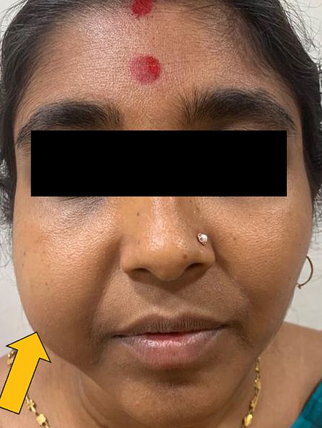 Припухлость при аденоме слюнной железы [13]