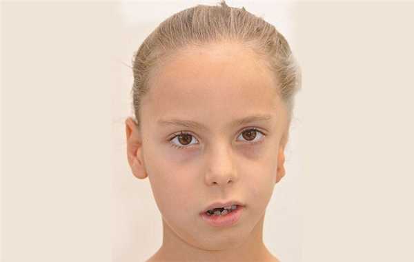 Какие Причины Гемифациального Низкорослости?