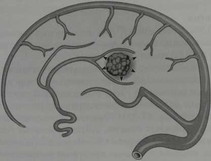 Снимки МРТ и КТ. Кавернозная гемангиома