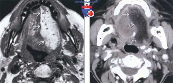Лучевая диагностика двигательной денервации подъязычного нерва (12 пары ЧМН)