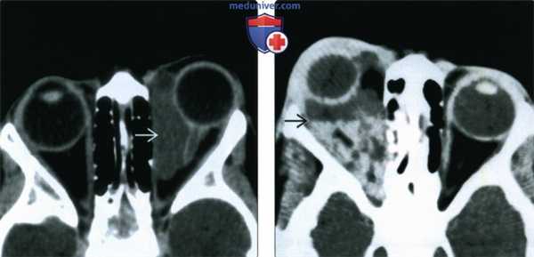КТ, МРТ при лимфатической мальформации глазницы