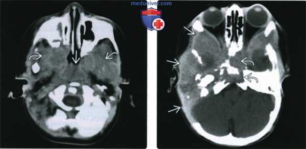 КТ, МРТ при лангергансоклеточном гистиоцитозе основания черепа
