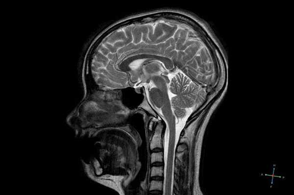 Гипофиз на снимке МРТ