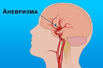 Аневризма сонной артерии