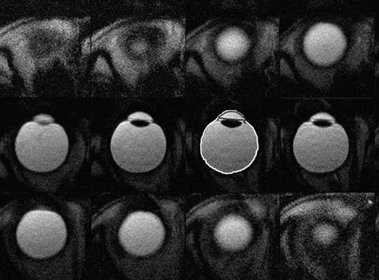 мрт головного мозга орбит это что