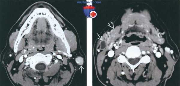 КТ, МРТ при опухоли Уортина